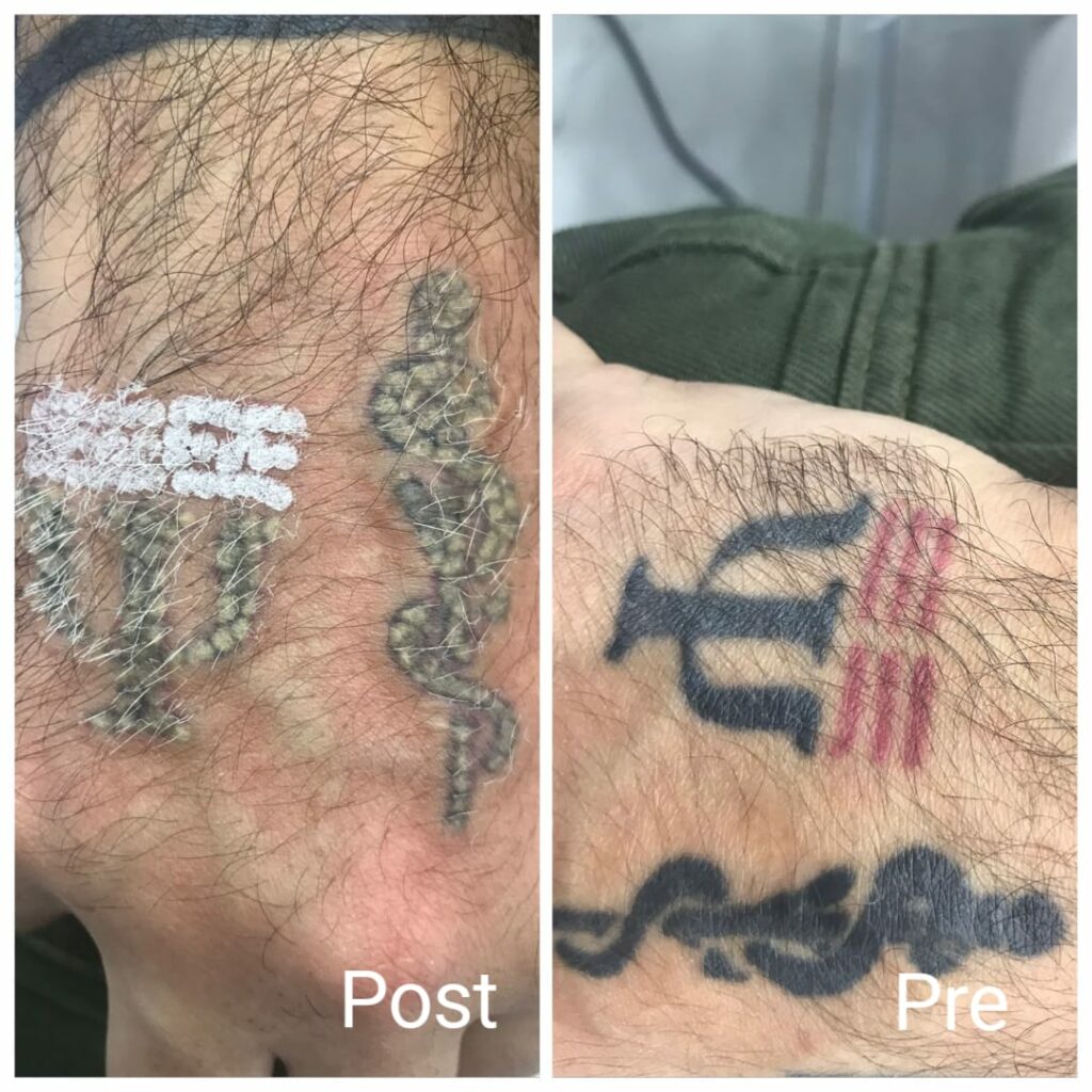 Laser removal of black and colored tattoos